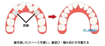 抜歯の対象となる歯