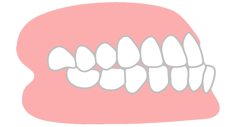 受け口・反対咬合（下顎前突）