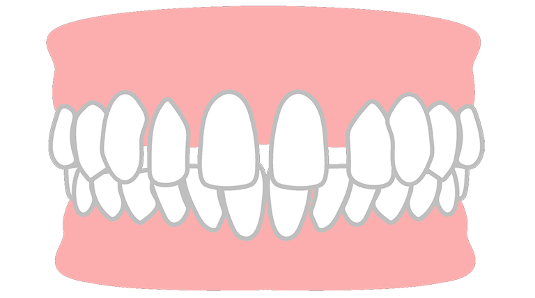 すきっ歯（空隙歯列）