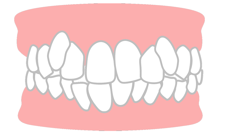 八重歯、叢生（乱杭歯）